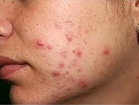 Treatment of All Skin Problems With Unani is The Best Treatment Treatment of All Skin Problems With Unani is The Best Treatment