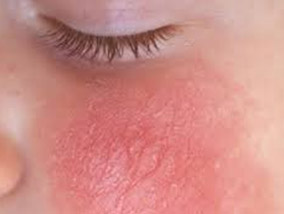 Treatment of All Skin Problems With Unani Ayurvedic Treatment and Medicine for Leucorrhoea