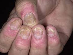 Ayurvedic Treatment and Medicine for Eczema Ayurvedic Treatment and Medicine for Eczema