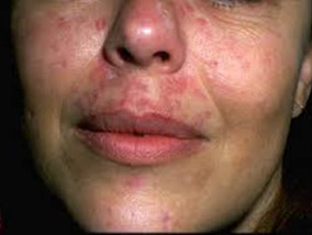 Lupus Lupus