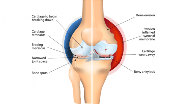 Arthritis Treatment in India