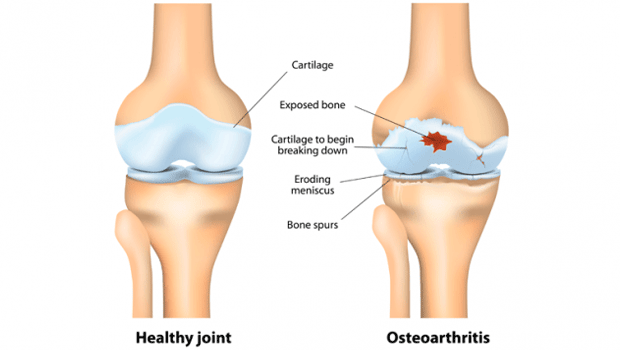 Arthritis Treatment in India