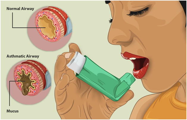 Ayurvedic treatment Asthma Ayurvedic treatment Asthma
