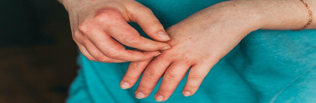 Ayurvedic Tips to Manage Skin/eczema System Ayurvedic Tips to Manage Skin/eczema System