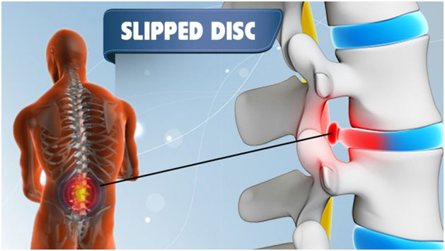 Ayurvedic Treatment of L5-S1 Slip Disc