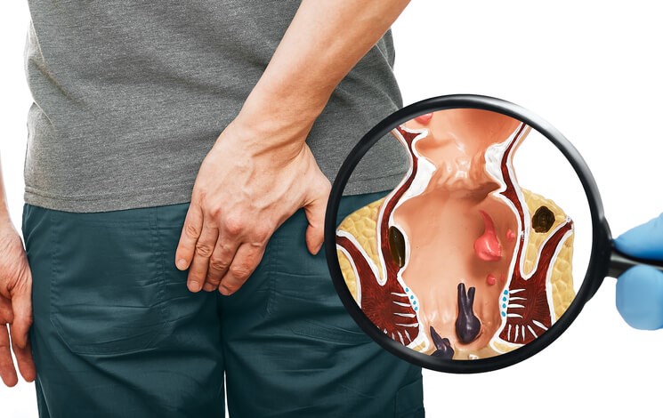 Ayurvedic treatment Piles Ayurvedic treatment Piles